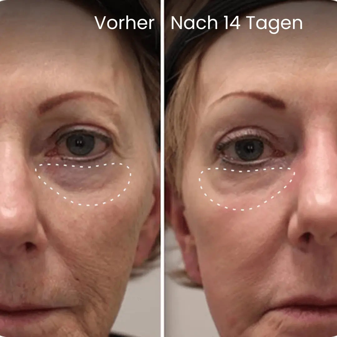 Glowlift Brille - Rotlichttherapie für eine strahlende Augenpartie